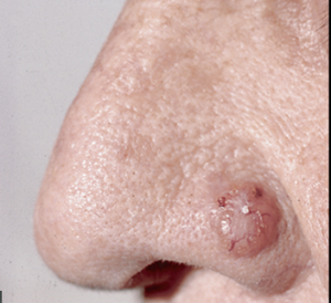 Internal Medicine Maintenance of Certification Conept Review - Basal Cell Carcinoma