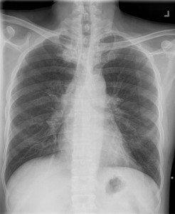 ABIM Board Exam Cadiology Challenge - Holosystolic Murmur