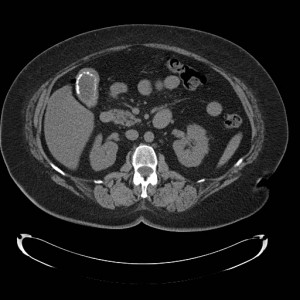 USMLE Step Exam Practice Question - Gallbladder Abdominal CT