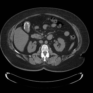 American Board of Internal Medicine Practice Review - Gallbladder Abdominal CT