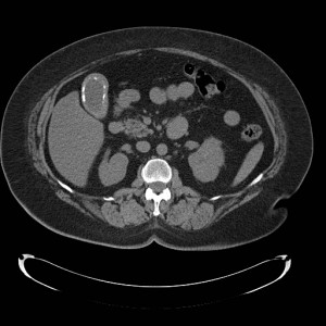 Medical Boards Practice Question - Gallbladder Abdominal CT