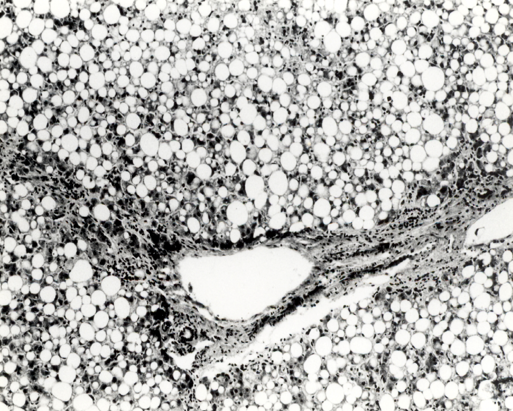 Liver Pathology