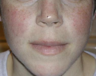 SLE Malar Rash