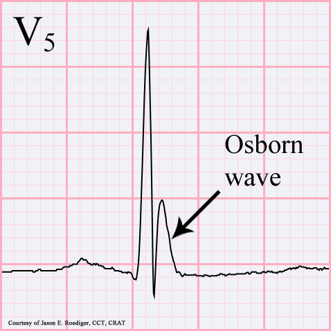 Osborn Wave